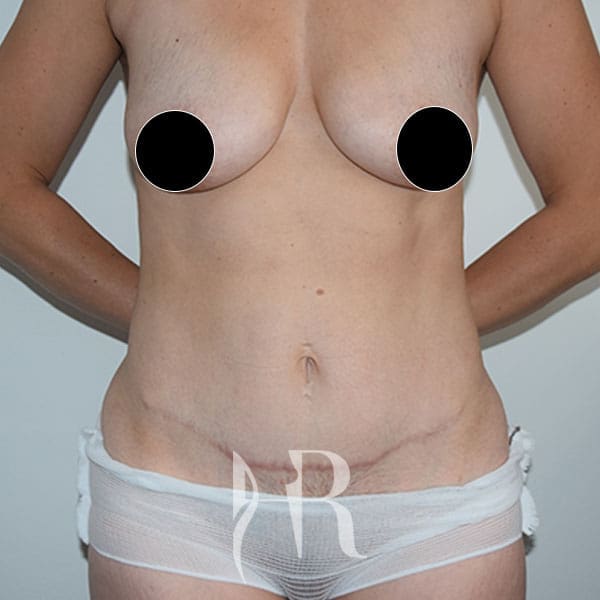 HR Plastic Surgery - Mini Tummy Tuck patient after 4